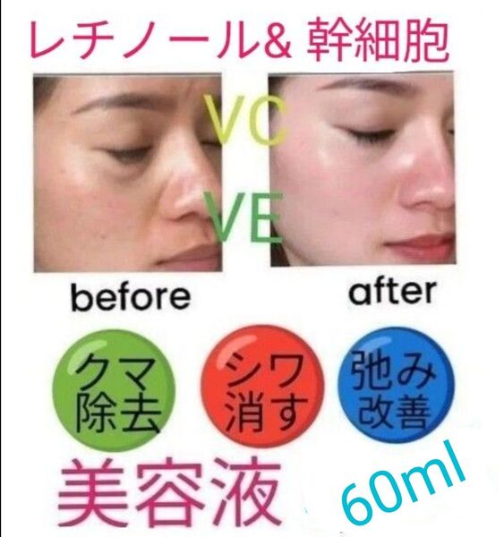 60mlレチノール&幹細胞ヒアルロン酸美容液llほうれい線マイクロニードルダーマペンしわダーマスタンプ水光注射