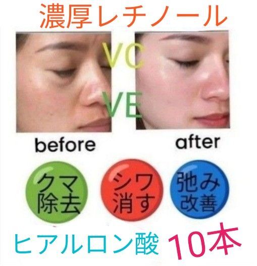 レチノール&ヒアルロン酸llほうれい線マイクロニードル美容液ダーマペンしわ改善ダーマスタンプ水光注射用に
