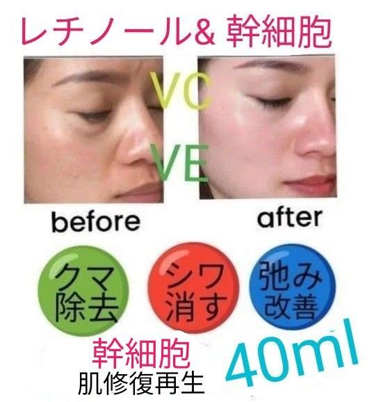 40mlレチノール&幹細胞ヒアルロン酸美容液llほうれい線マイクロニードルダーマペンしわダーマスタンプ水光注射