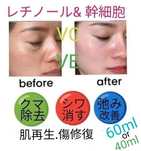 40ml or 60mlレチノール&幹細胞ヒアルロン酸美容液llほうれい線マイクロニードルダーマペンしわダーマスタンプ水光注射