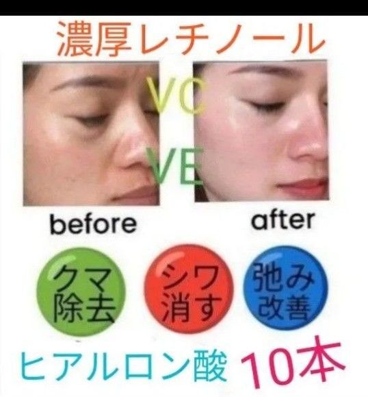 10本レチノール&ヒアルロン酸llほうれい線マイクロニードル美容液ダーマペンしわ改善ダーマスタンプ水光注射用に