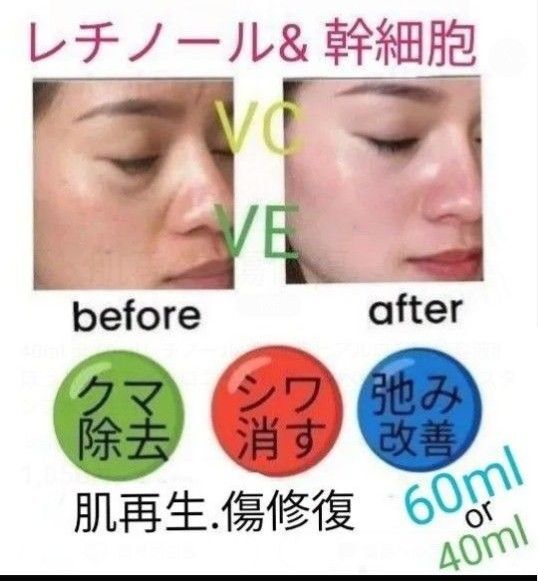 40ml or 60mlレチノール&幹細胞ヒアルロン酸美容液llほうれい線マイクロニードルダーマペンしわダーマスタンプ水光注射
