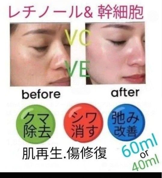 40ml or 60mlレチノール&幹細胞ヒアルロン酸美容液llほうれい線マイクロニードルダーマペンしわダーマスタンプ水光注射