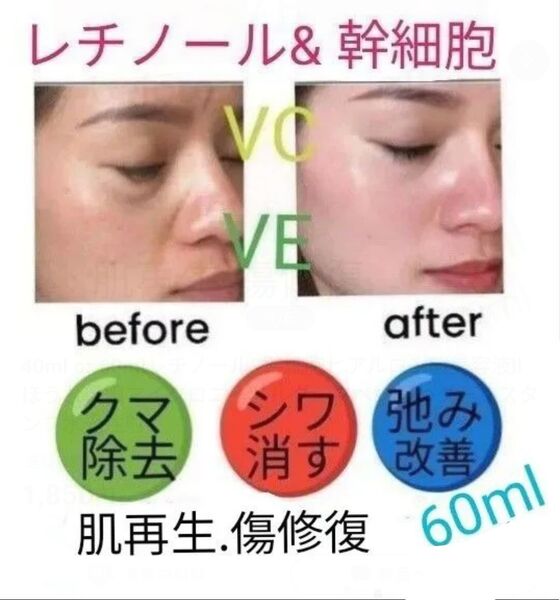 60mlレチノール&幹細胞ヒアルロン酸美容液llほうれい線マイクロニードルダーマペンしわダーマスタンプ水光注射