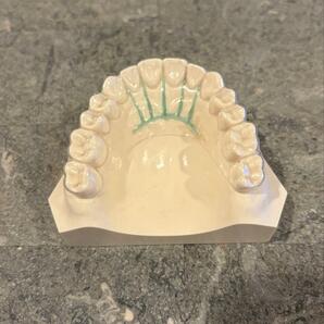 アライナーマウスピース矯正患者説明用模型 歯科医院 小児歯科矯正歯科