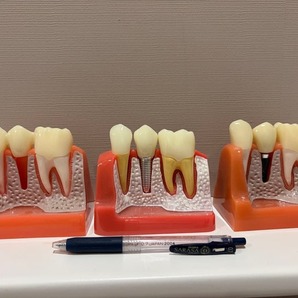 3点セット インプラントブリッジ説明模型歯科医院患者説明