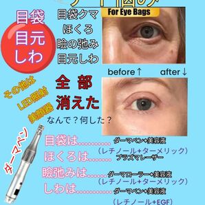 正規品USB充電式電動ダーマペン42針ヘッド付 - ほうれい線マイクロニードル小顔ダーマスタンプ頭皮ダーマローラー育毛スカルプ薄毛