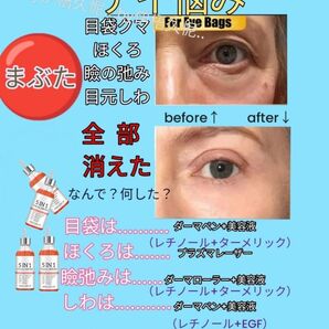 ヒアルロン酸美容液30mlx4保湿llほうれい線マイクロニードル美容液ダーマペンしわダーマスタンプ水光注射ダーマローラー