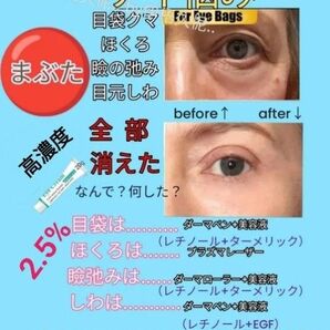 レチナール活性化高濃度2.5%レチノール 20gllほうれい線マイクロニードルダーマペン目元しわ瞼弛みダーマスタンプ水光注射