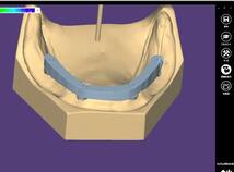 歯科　歯科技工　インプラントバー構造データ作成手順　mp4動画　_画像1