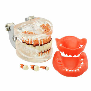 cc高級歯列模型 ペリオ上下顎歯科模型 歯周病 歯槽膿漏 歯周疾患 大人用