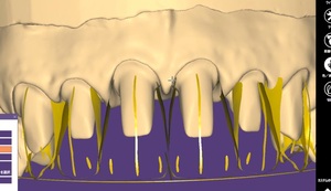 歯科　歯科技工　上顎前歯用配列ガイド3D　デンタルデザインツール ラインガイド　stlメッシュ　