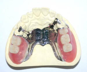 歯科 部分床義歯 金属床 パーシャルデンチャー サンプル 模型 見本 入れ歯 補綴 フルデンチャー 説明 技工 資料 自費 2