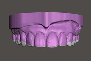 歯科　歯科技工　フルデジタルワーク アンダーカット 処理および必要な箇所のアンダーカット回復方法　mp4動画