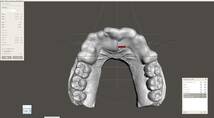 歯科　歯科技工　デジタルクラウンレングスニングガイドデータ作成手順動画　mp4 meshmixer_画像6