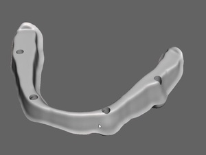 歯科　歯科技工　インプラント上部構造のバータイプ内部補強構造の製作手順　mp4