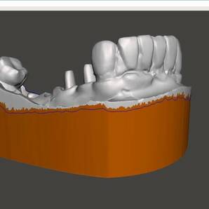 歯科 歯科技工 3Dプリントにインプラントレプリカを戻すための製作手順書 Meshmixer+Labo Scannerの画像5