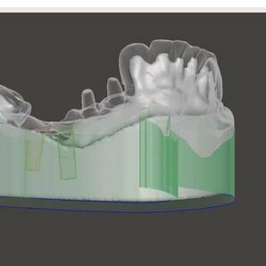 歯科 歯科技工 3Dプリントにインプラントレプリカを戻すための製作手順書 Meshmixer+Labo Scannerの画像6