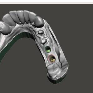 歯科 歯科技工 3Dプリントにインプラントレプリカを戻すための製作手順書 Meshmixer+Labo Scannerの画像8