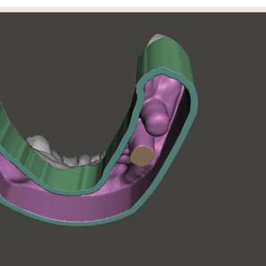 歯科 歯科技工 3Dプリントにインプラントレプリカを戻すための製作手順書 Meshmixer+Labo Scannerの画像7