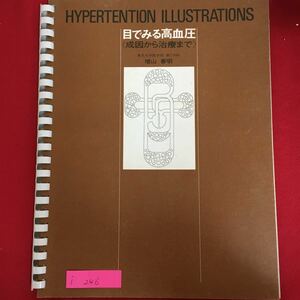 i-246※6/HYPERTENTION ILLUSTRATIONS 目でみる高血圧〈成因から治療まで 東京大学医学部第内科 增山 善明 発行年月日不明 