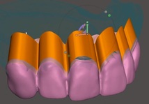 歯科　歯科技工　義歯スキャンデータからコピーデンチャーのデータ製作　義歯データからのモデルデータ製作手順動画　mp4_画像4