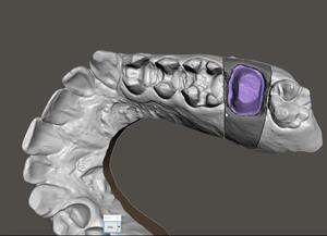 歯科　歯科技工　モデリングカットパーツを使用したガム部が分離できるデータ作成手順動画　mp4 ios ガム部処理　3Dプリント