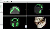 歯科　歯科技工　ダイコムデータから骨や歯のデータを抜き出す手順動画　mp4 CBCT _画像2