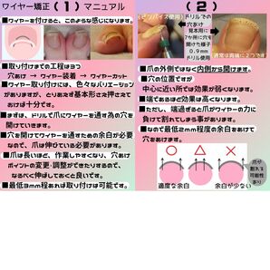 【巻き爪ケア】ワイヤー矯正マニュアル無料