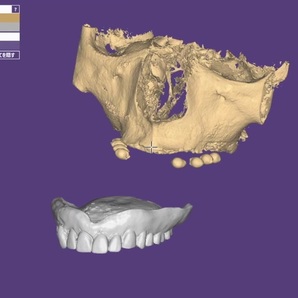 歯科 歯科技工 ダイコムデータから骨や歯のデータを抜き出す手順動画 mp4 CBCT の画像8