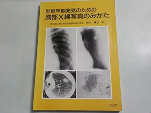 P0174◆肺癌早期発見のための胸部X線写真のみかた 鈴木謙三 文光堂☆