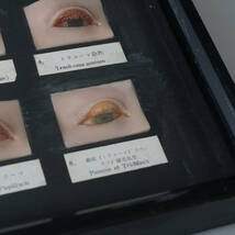 昭和32年 トラコーマ結膜炎模型 オブジェ 置物 サンプル 医学資料 目 眼 眼科学 病気 症例_画像6