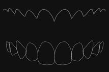 歯科　歯科技工　ティーステンプレート　ガムラインテンプレート　stl　審美・診断用テンプレート　デジタルデザインツール_画像4