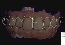 歯科　歯科技工　ティーステンプレート　ガムラインテンプレート　stl　審美・診断用テンプレート　デジタルデザインツール_画像9
