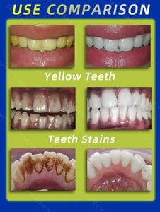 [ новый товар нераспечатанный ] зуб камень удалитель зуб. отбеливание зуб. загрязнения. удаление неприятный запах изо рта. удаление неприятный запах изо рта 