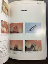 歯科学　書籍　イミディエイトロードインプラント: 21世紀の審美インプラントシステム　A52405_画像8