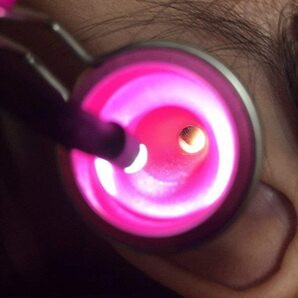 耳穴掃除セット 耳鏡 LEDライト付き 先端細ピンセット付き 2点セット / 医療用ライト 耳掃除器具 子供・大人兼用 (ピンク)の画像3