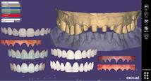 歯科　歯科技工　デジタルデンタルパーツ　スマイルデザイン用　カラーテンプレート＋ラインテンプレート＋ゴールデンプロポーションガイド_画像4