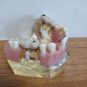 歯科　インプラント説明模型　