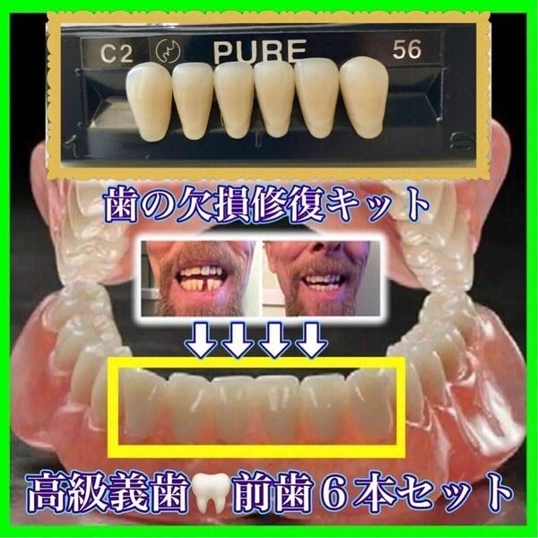 正規品 （前歯下段６本）歯科人工歯 歯の欠損修復 高品質樹脂製 高級義歯全６個セット 義歯 仮歯 付け歯 入れ歯 インスタントスマイル FX