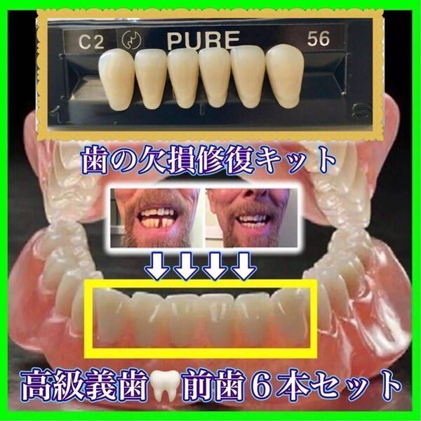 正規品 (前歯下段6本)歯科人工歯 歯の欠損修復 高品質樹脂製 高級義歯全6個セット 義歯 仮歯 付け歯 入れ歯 インスタントスマイル M