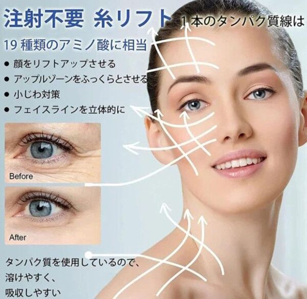 刺さない溶ける糸リフト(12本入り×5袋)×2セット