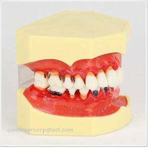cc高級歯列模型 ペリオ上下顎歯科模型 歯周病 歯槽膿漏 歯周疾患